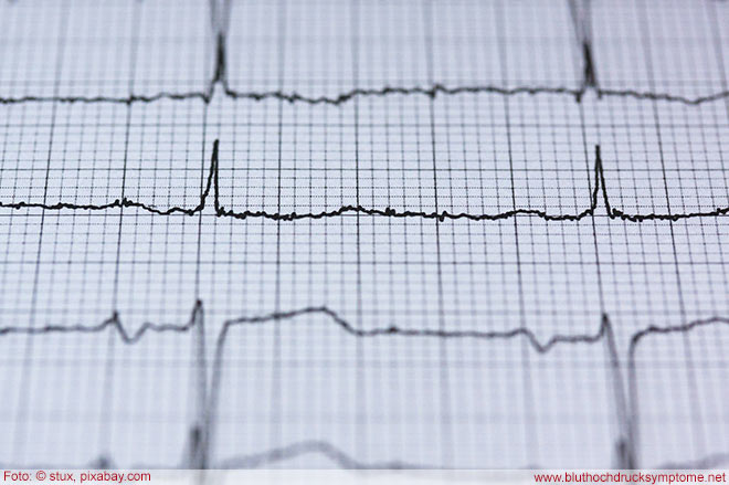 Richtwerte für Bluthochdruck gesenkt - Ein EKG misst die Herzschläge - Herzkranken stehen oft im Zusammenhang mit Bluthochdruck.